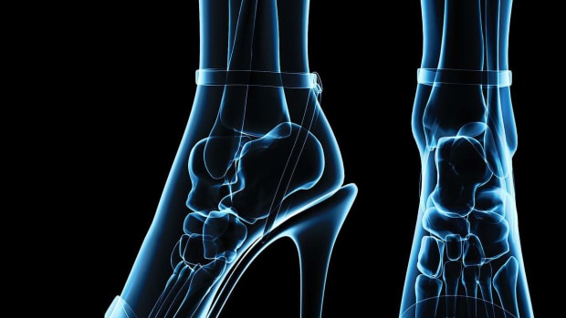 ZQ. How to Recognize Haglund's Deformity | Foot Care Promo Image