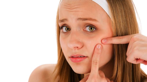 N. What Are Home Remedies That Work for Treating Acne? Promo Image