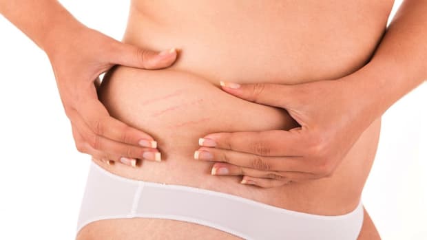 ZK. Does a Tummy Tuck Get Rid of Stretch Marks? Promo Image