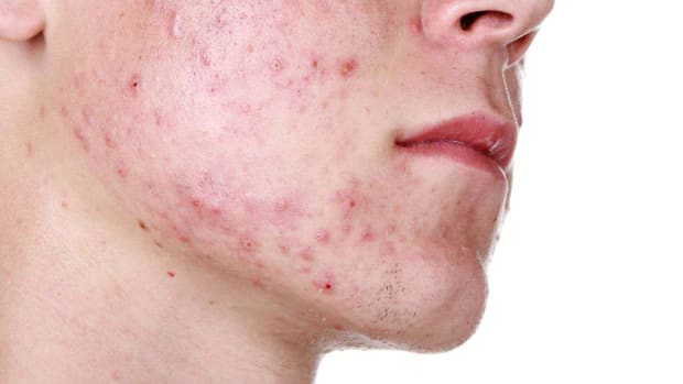X. How to Shave Acne-Prone Skin Promo Image