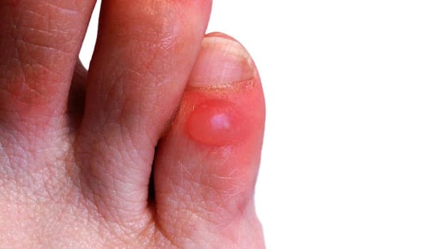 X. How to Prevent & Treat Foot Blisters | Foot Care Promo Image
