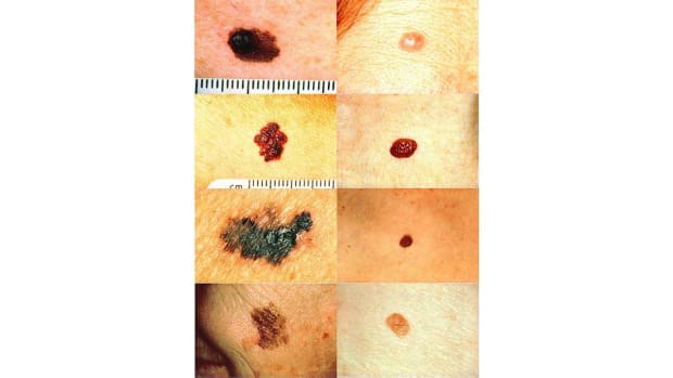 B. How to Spot Skin Cancer Promo Image