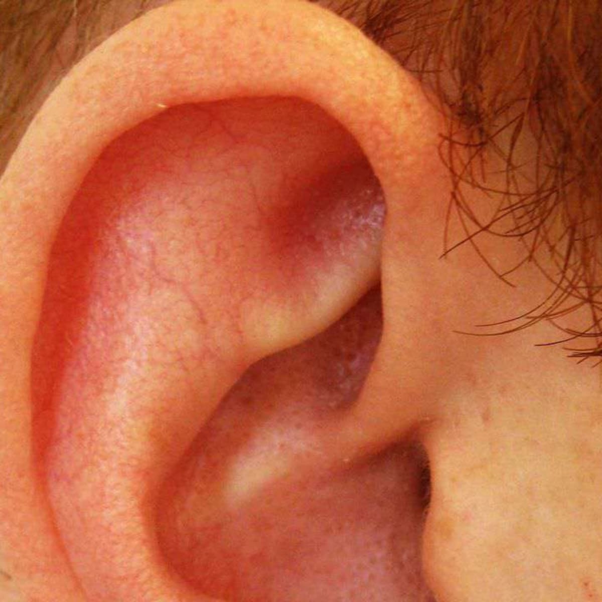 Infected cartilage top