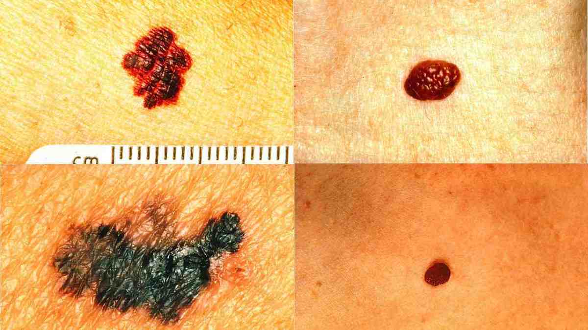 What Does Melanoma Look Like Howcast