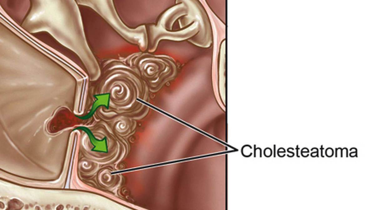 Ear Cysts Popping