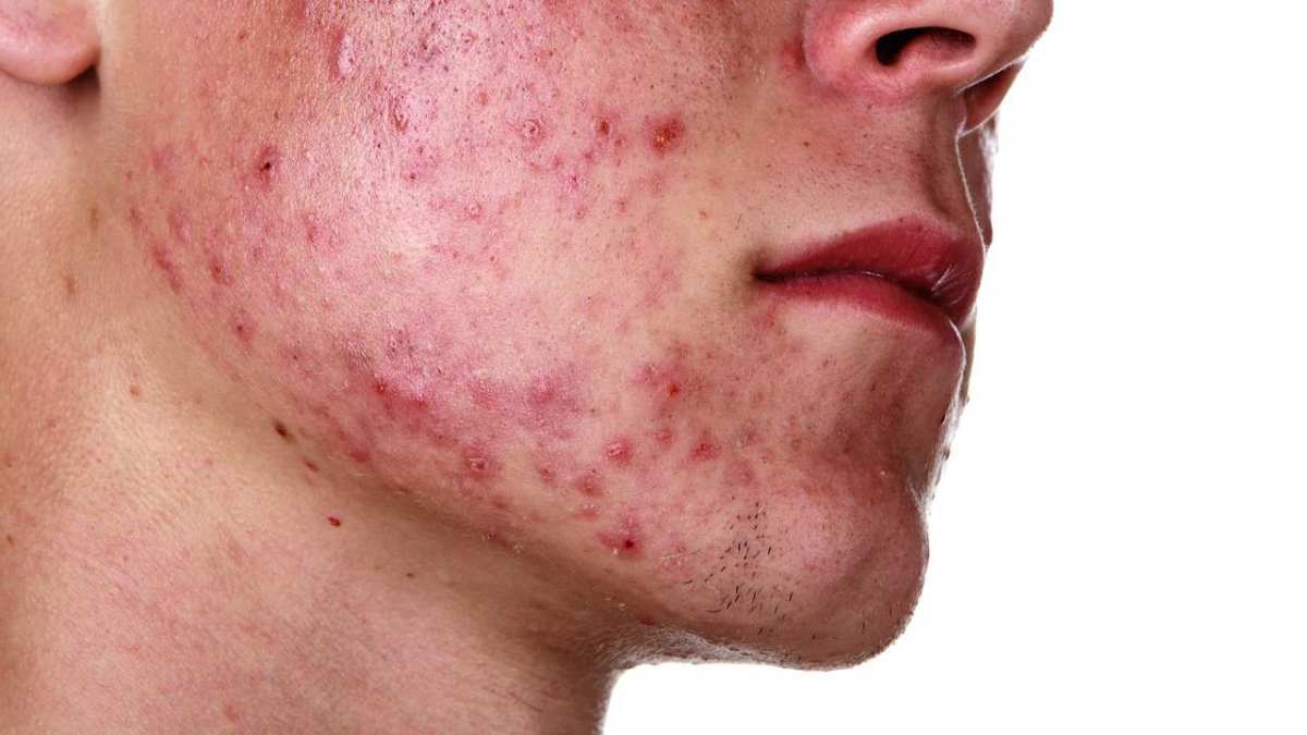 How to Control & Treat Severe Acne - Howcast
