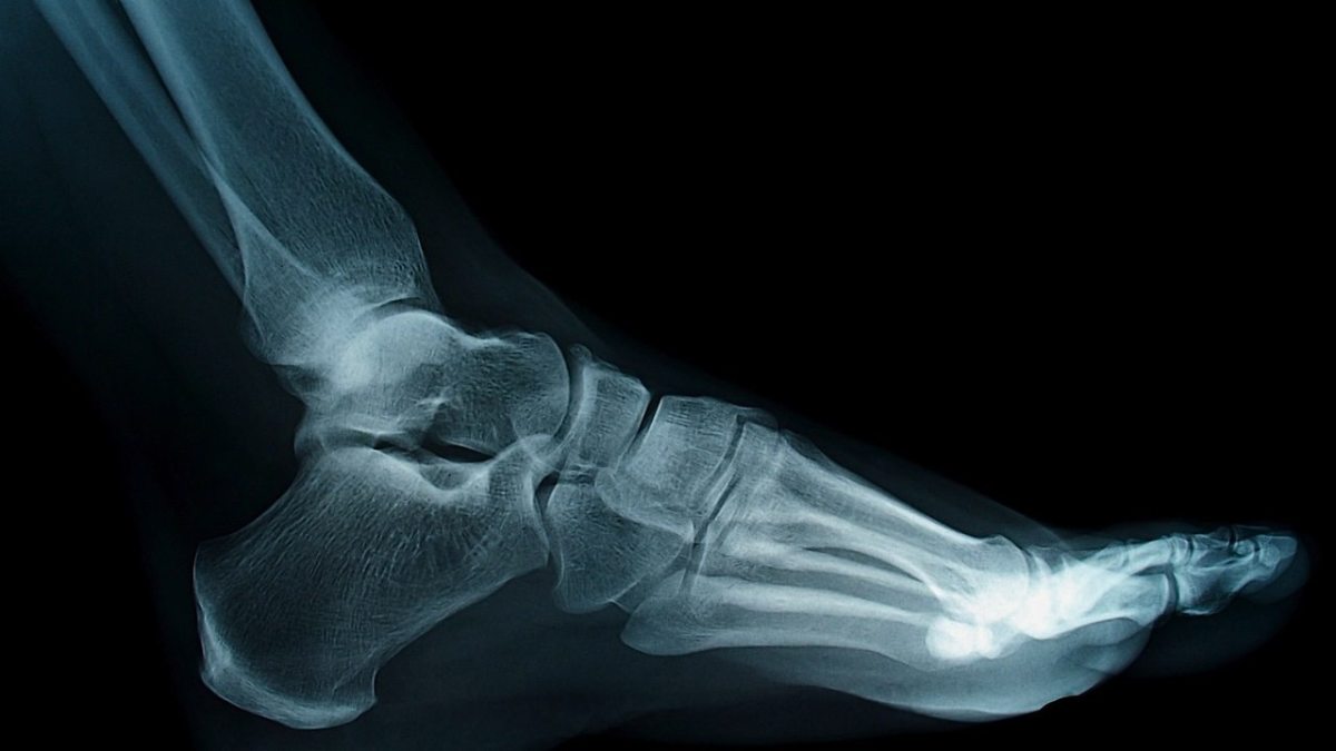 How to Know If You Have Flat Feet Foot Care Howcast