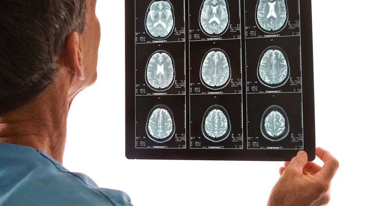 Trileptal headache x ray